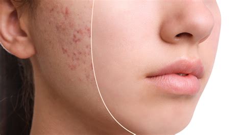 boni scars|14 Ways to Get Rid of Acne Scars